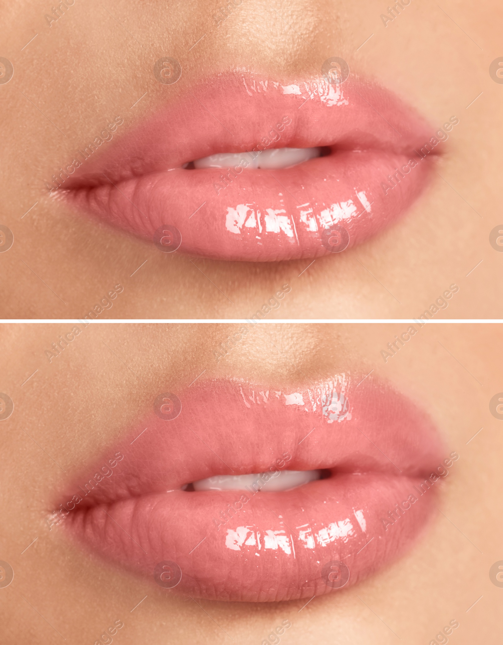Image of Woman before and after lip correction procedure, closeup 