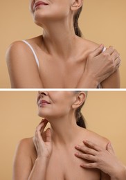 Image of Collage with photos of woman before and after cosmetic procedure on beige background, closeup