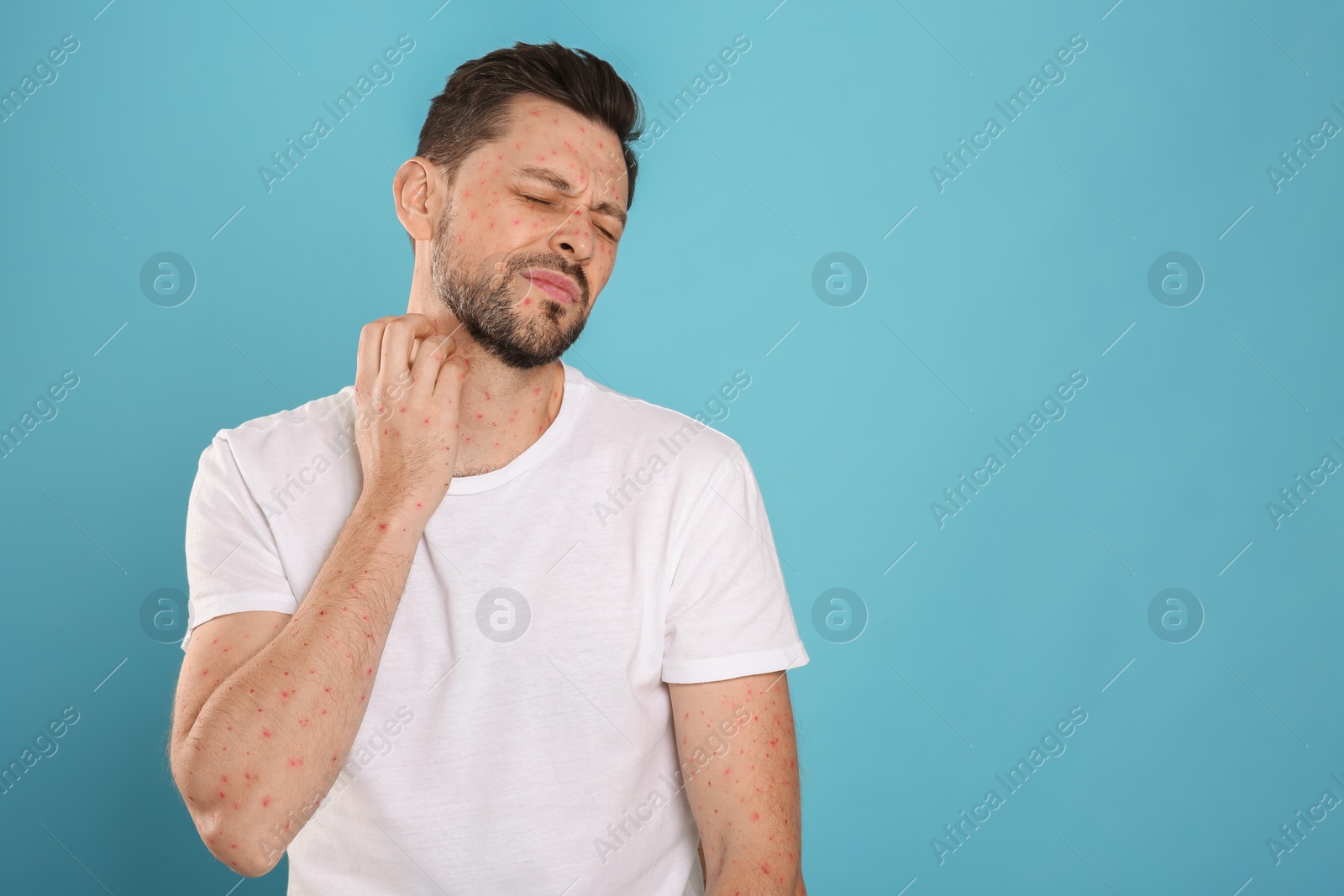 Photo of Man with rash suffering from monkeypox virus on light blue background. Space for text