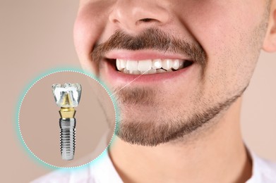 Image of Man with beautiful smile after dental implant installation procedure on beige background, closeup