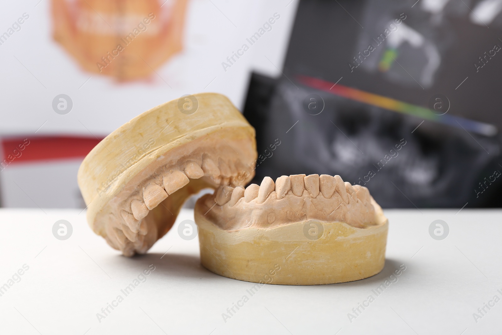 Photo of Dental model with gums on white table against panoramic x-ray. Cast of teeth