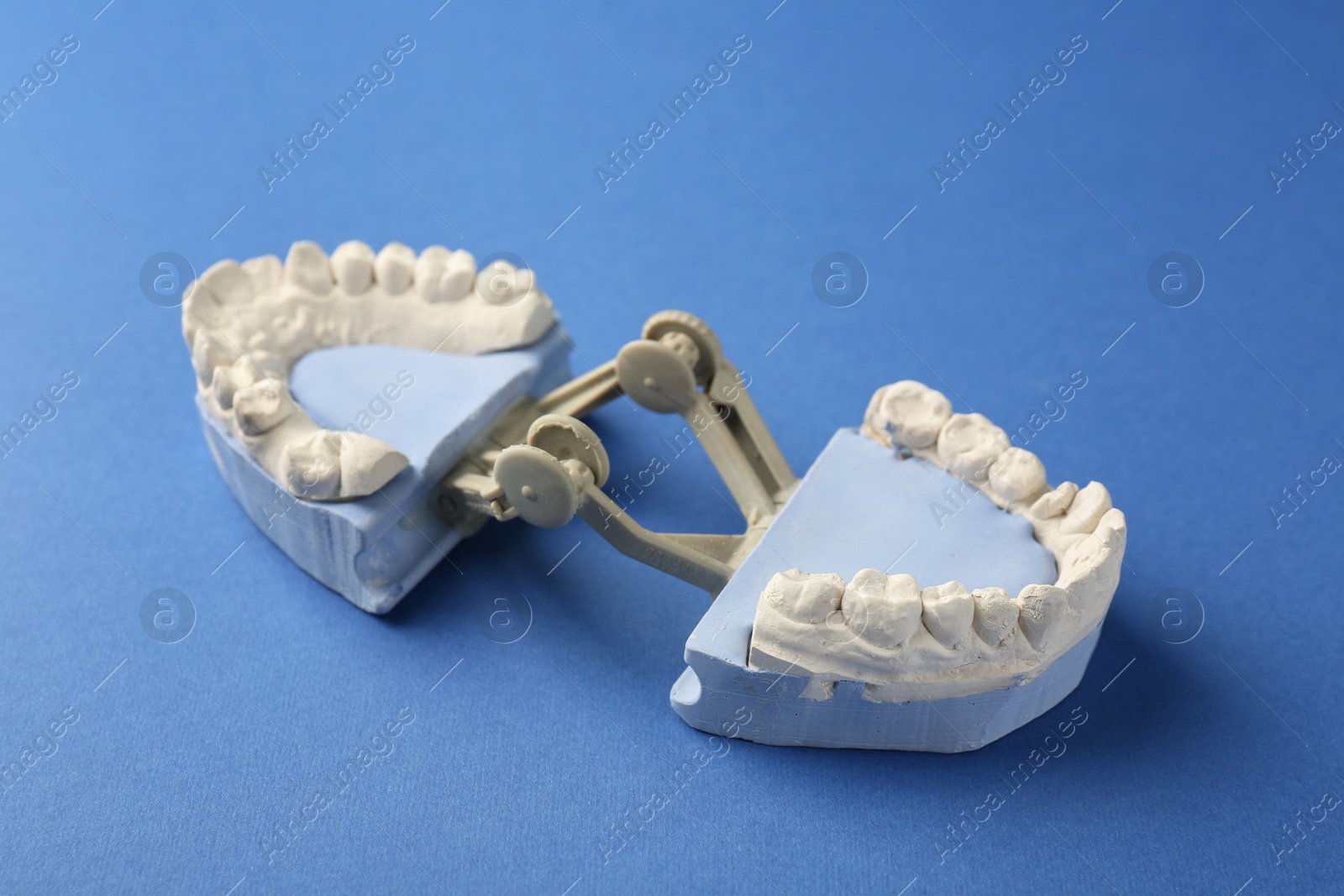 Photo of Dental model with gums on blue background. Cast of teeth