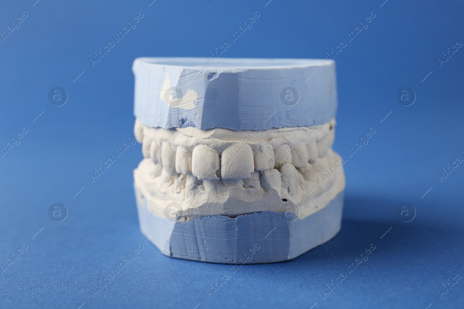 Photo of Dental model with gums on blue background. Cast of teeth