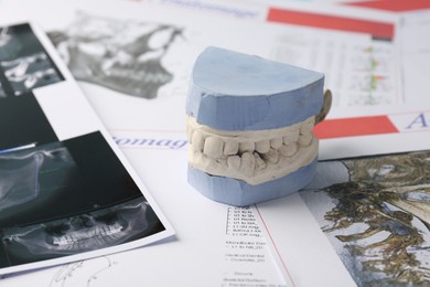 Photo of Dental model with gums, anatomy charts and panoramic x-ray. Cast of teeth