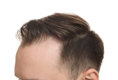 Baldness concept. Man with receding hairline on white background, closeup