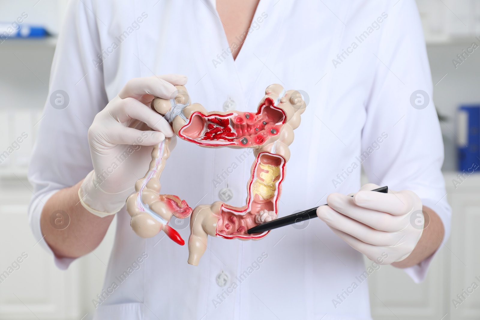 Photo of Doctor showing model of large intestine in clinic, closeup