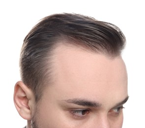 Photo of Baldness concept. Man with receding hairline on white background, closeup