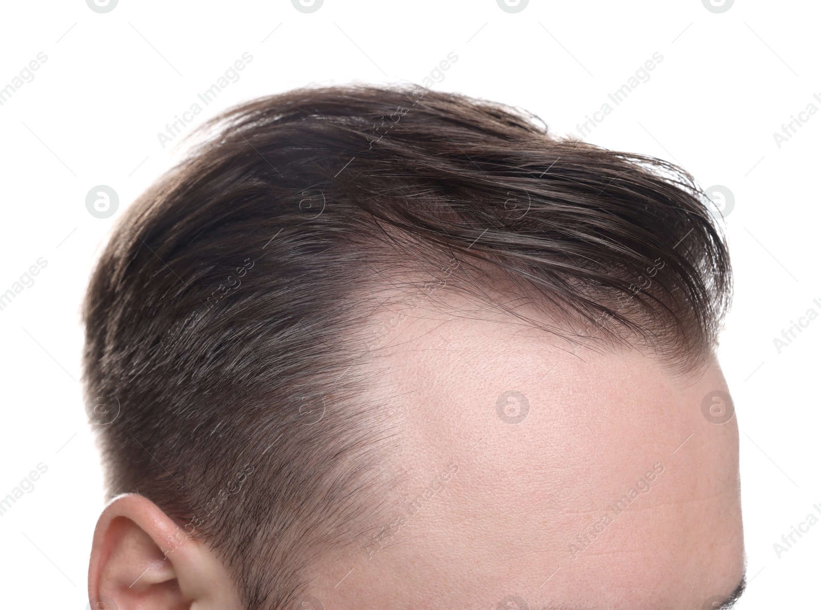 Photo of Baldness concept. Man with receding hairline on white background, closeup