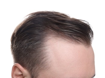 Baldness concept. Man with receding hairline on white background, closeup