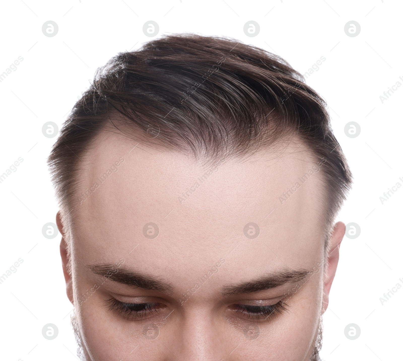 Photo of Baldness concept. Man with receding hairline on white background, closeup