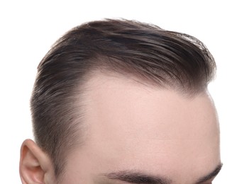 Baldness concept. Man with receding hairline on white background, closeup