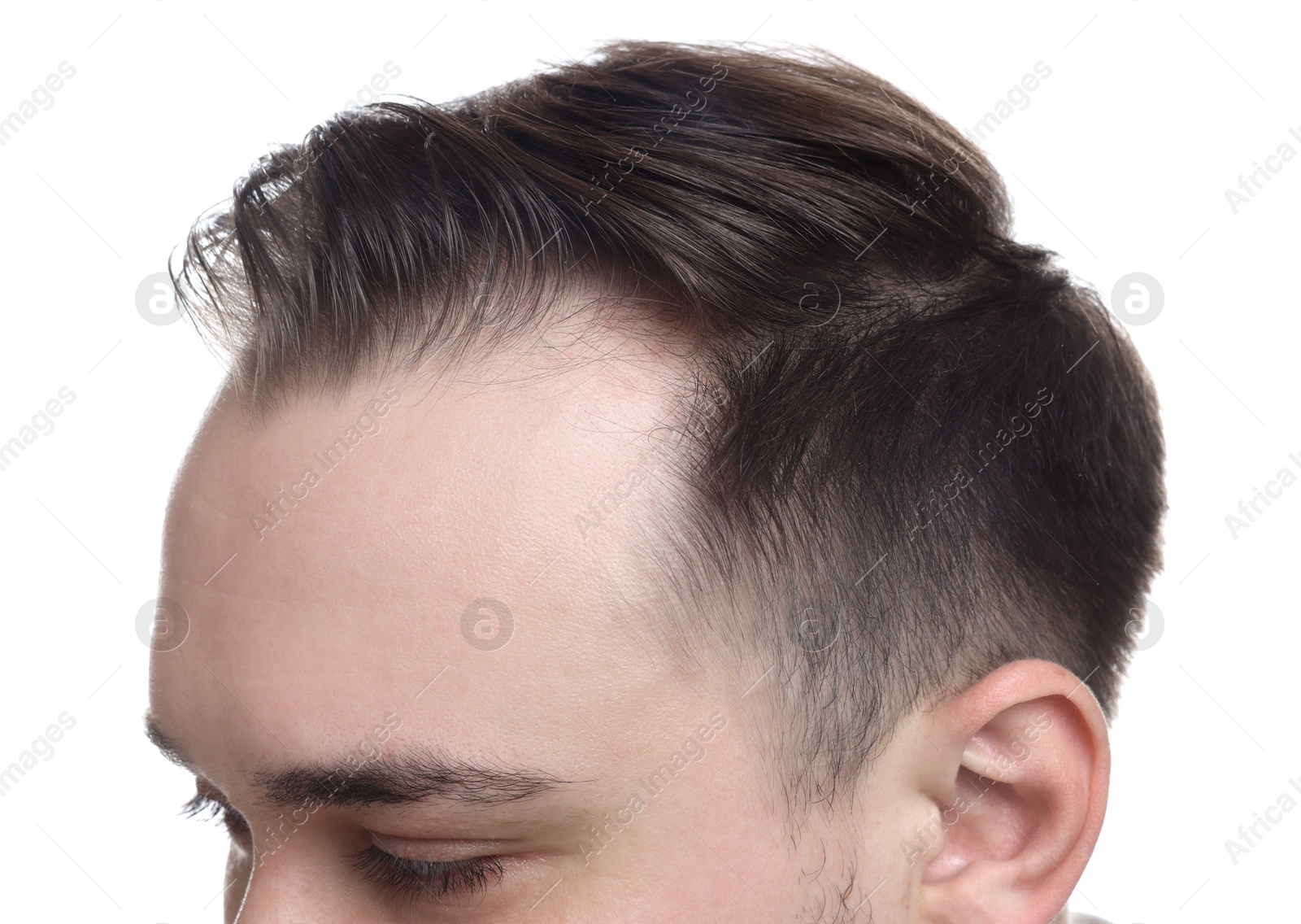 Photo of Baldness concept. Man with receding hairline on white background, closeup