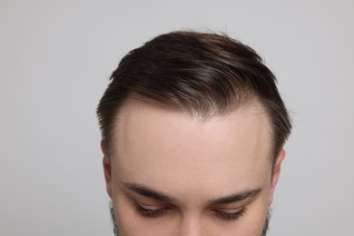 Photo of Baldness concept. Man with receding hairline on light grey background, closeup