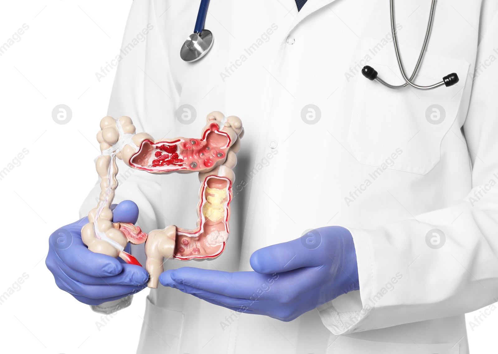 Photo of Doctor with model of large intestine on white background, closeup