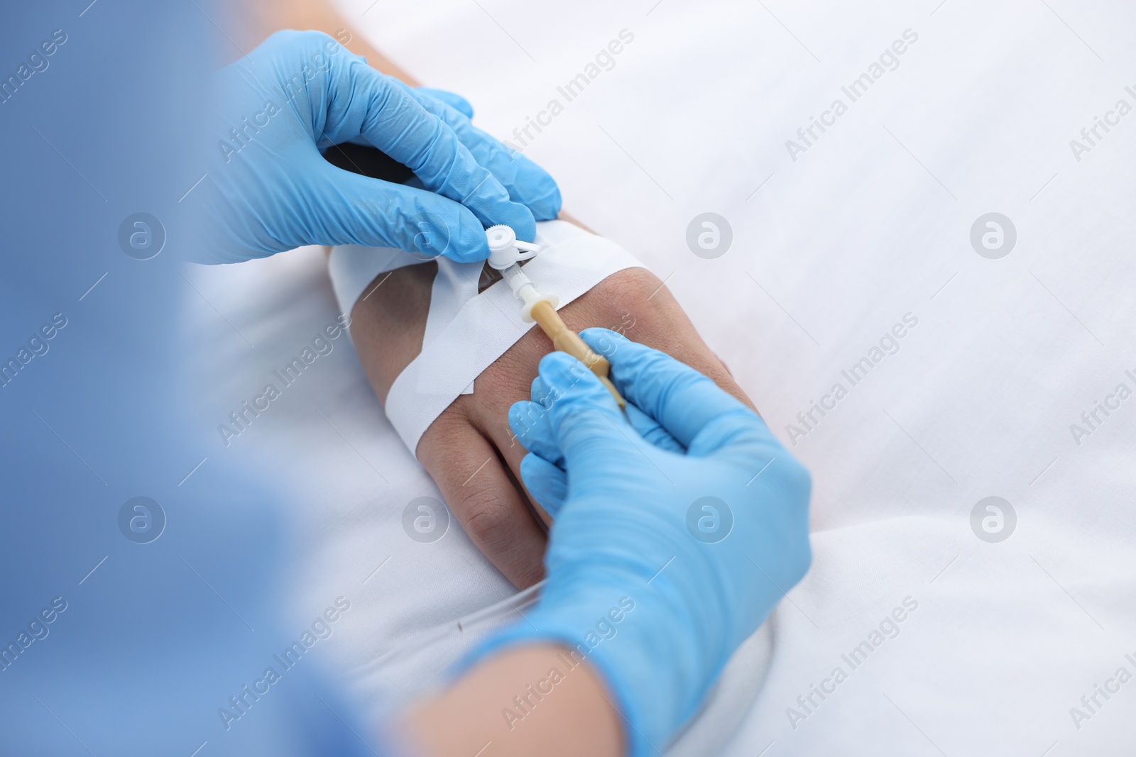 Photo of Nurse inserting IV into arm of patient in hospital, closeup