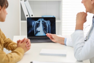 Photo of Lung cancer. Doctor showing chest x-ray on laptop to her patient in clinic, closeup