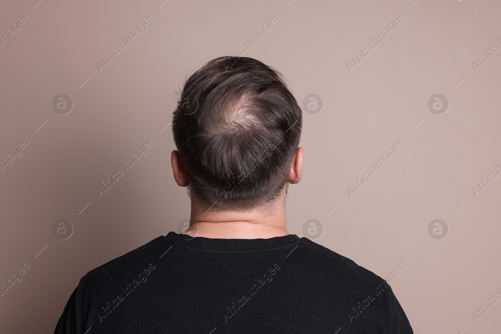 Photo of Baldness concept. Man with bald spot on beige background, back view