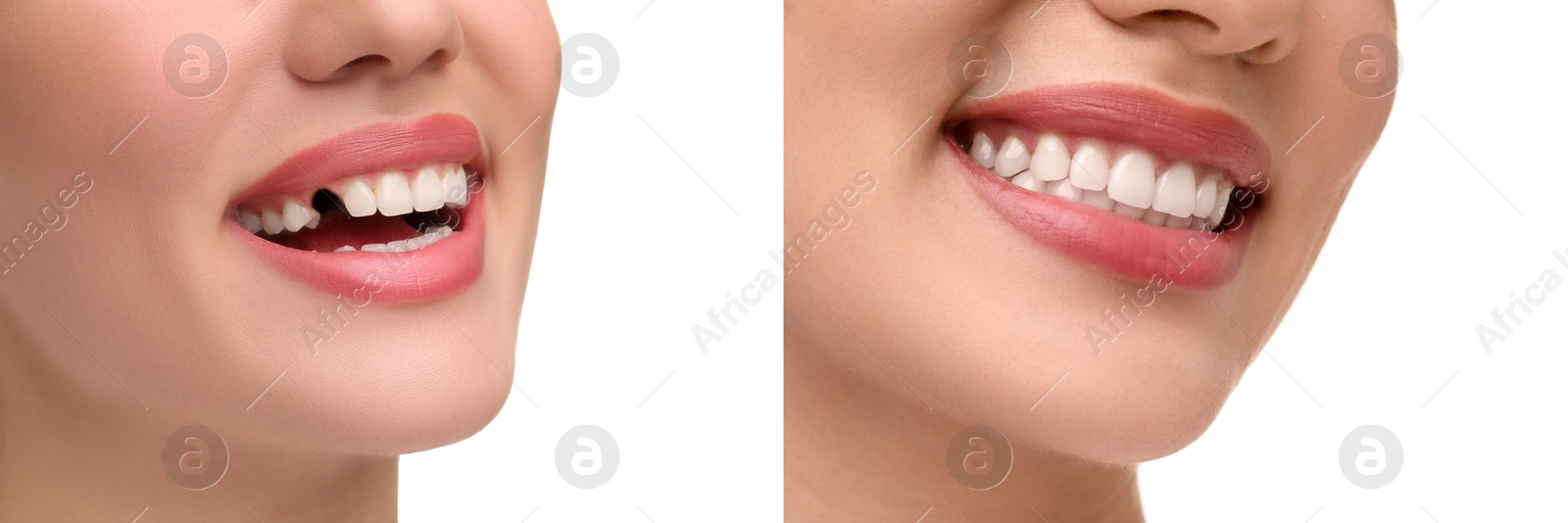 Image of Woman showing teeth before and after dental implant surgery, closeup. Collage of photos on white background