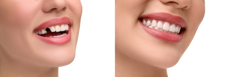 Woman showing teeth before and after dental implant surgery, closeup. Collage of photos on white background