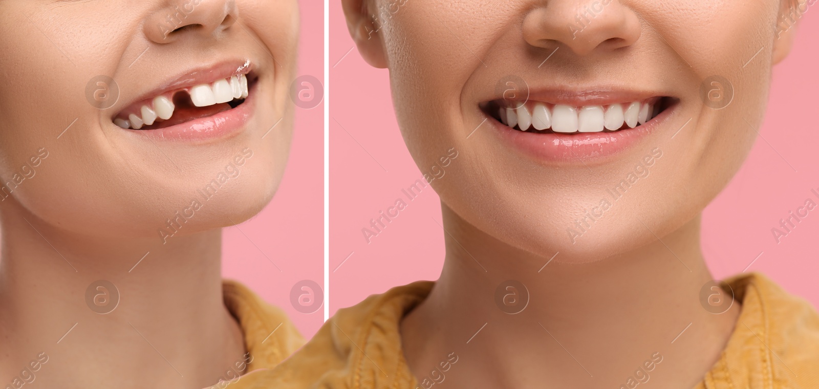 Image of Woman showing teeth before and after dental implant surgery, closeup. Collage of photos on pink background