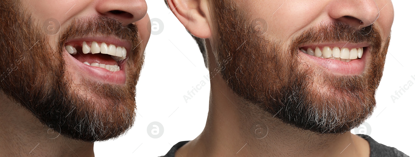 Image of Man showing teeth before and after dental implant surgery, closeup. Collage of photos on white background