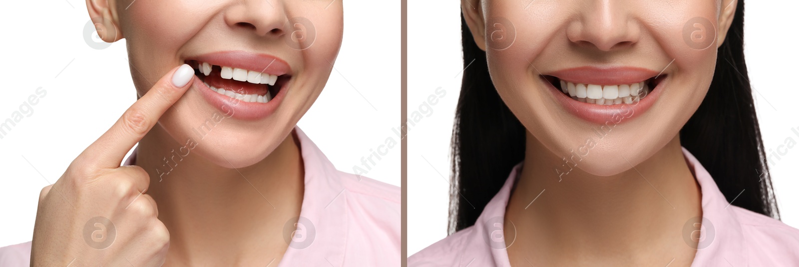 Image of Woman showing teeth before and after dental implant surgery, closeup. Collage of photos on white background