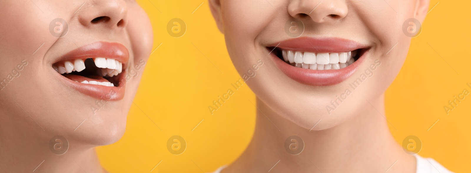 Image of Woman showing teeth before and after dental implant surgery, closeup. Collage of photos on yellow background