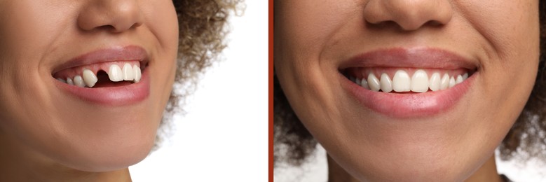 Image of Woman showing teeth before and after dental implant surgery, closeup. Collage of photos on white background