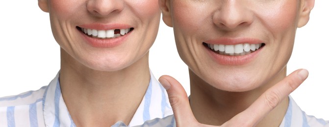 Image of Woman showing teeth before and after dental implant surgery, closeup. Collage of photos on white background