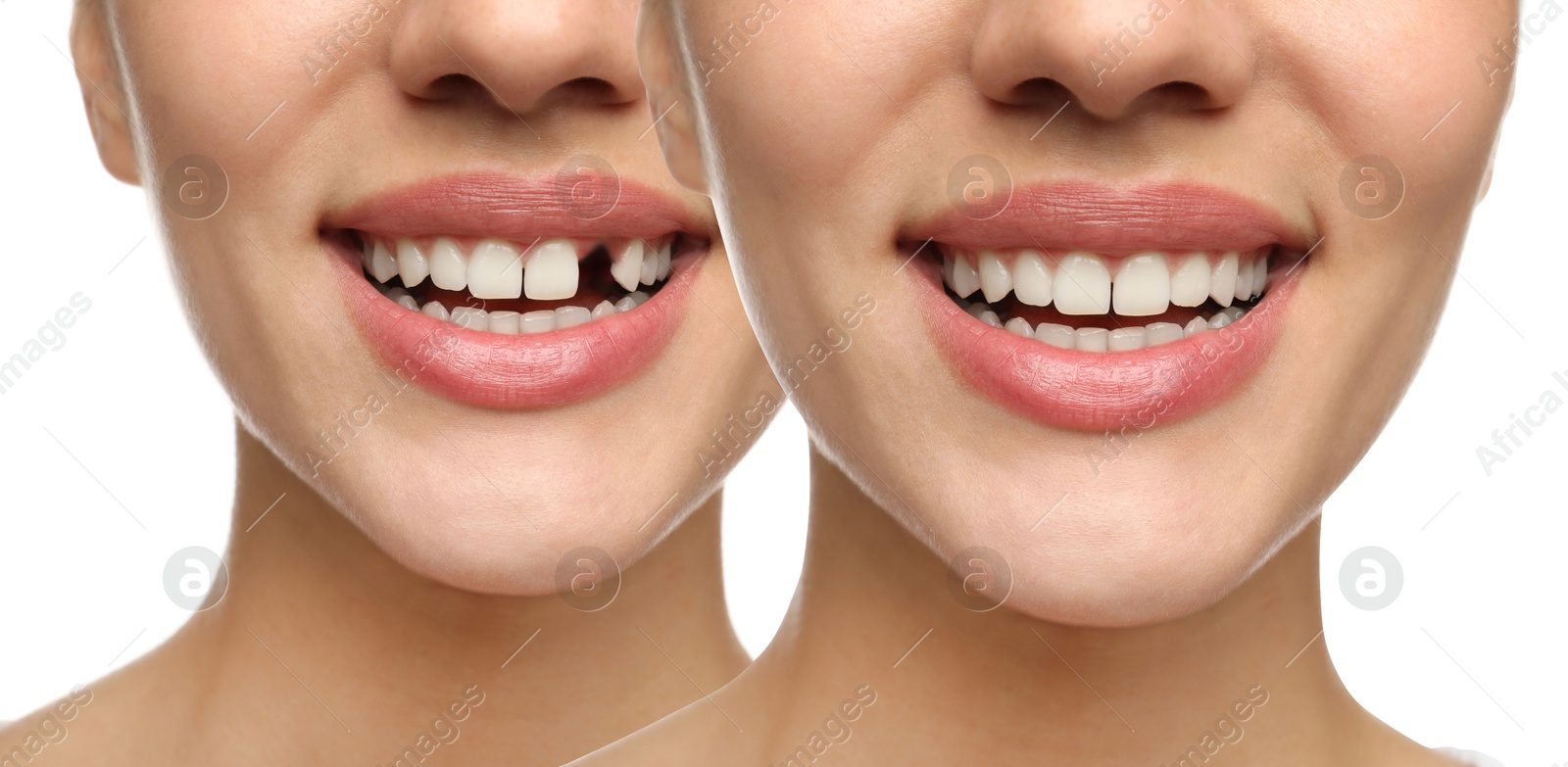 Image of Woman showing teeth before and after dental implant surgery, closeup. Collage of photos on white background