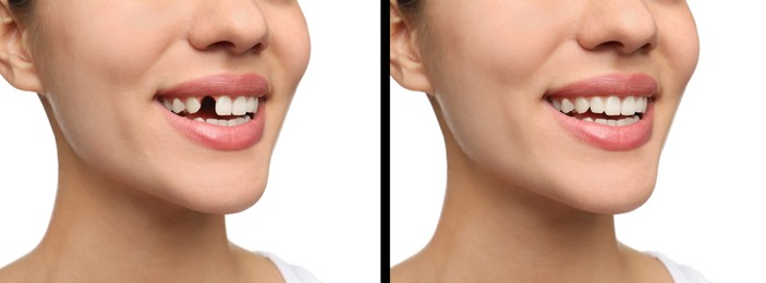 Woman showing teeth before and after dental implant surgery, closeup. Collage of photos on white background