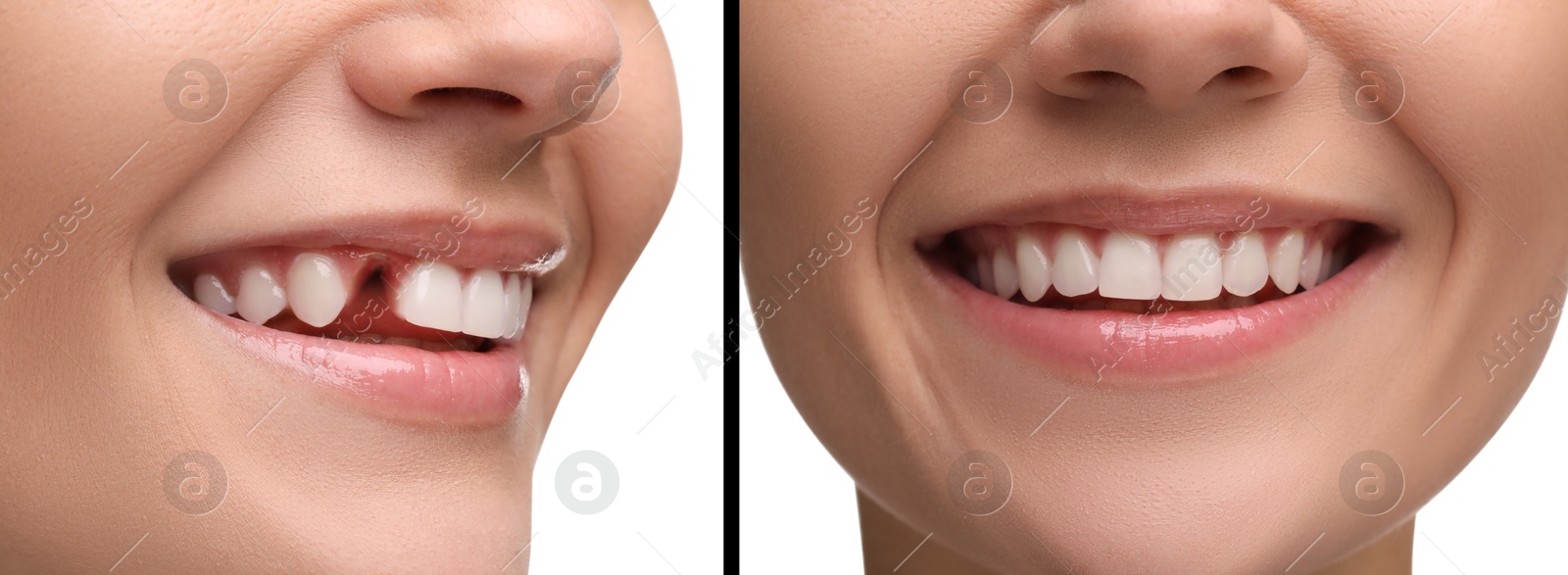 Image of Woman showing teeth before and after dental implant surgery, closeup. Collage of photos on white background