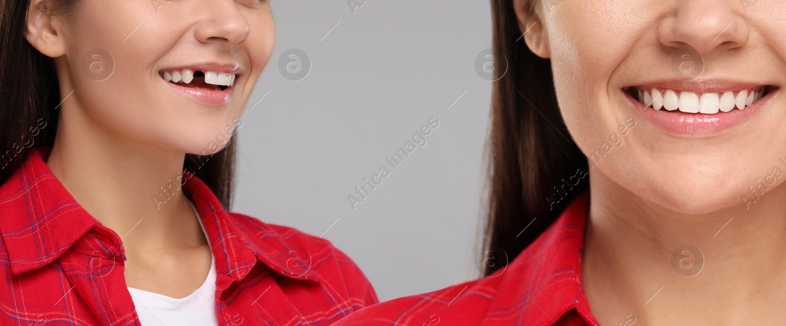 Image of Woman showing teeth before and after dental implant surgery, closeup. Collage of photos on grey background