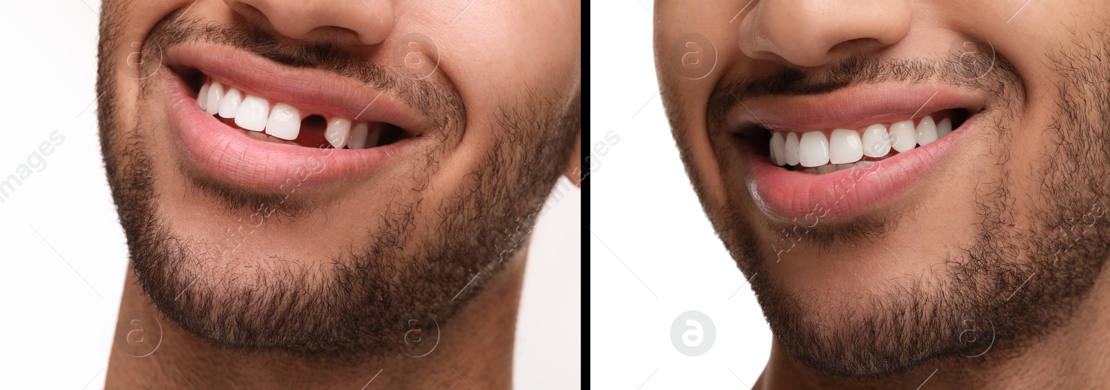 Image of Man showing teeth before and after dental implant surgery, closeup. Collage of photos on white background