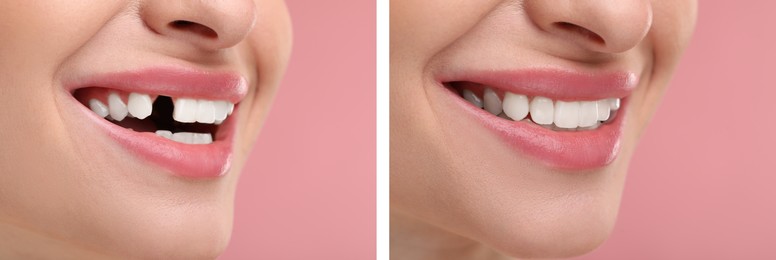 Image of Woman showing teeth before and after dental implant surgery, closeup. Collage of photos on pink background