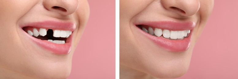 Woman showing teeth before and after dental implant surgery, closeup. Collage of photos on pink background