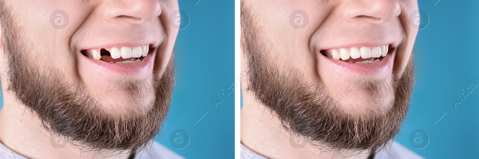 Image of Man showing teeth before and after dental implant surgery, closeup. Collage of photos on blue background