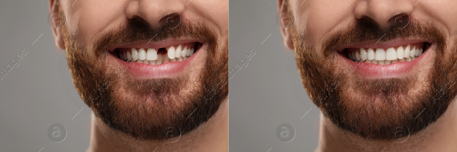 Image of Man showing teeth before and after dental implant surgery, closeup. Collage of photos on grey background