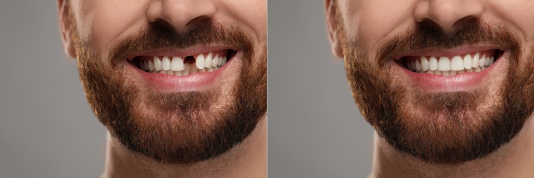 Image of Man showing teeth before and after dental implant surgery, closeup. Collage of photos on grey background