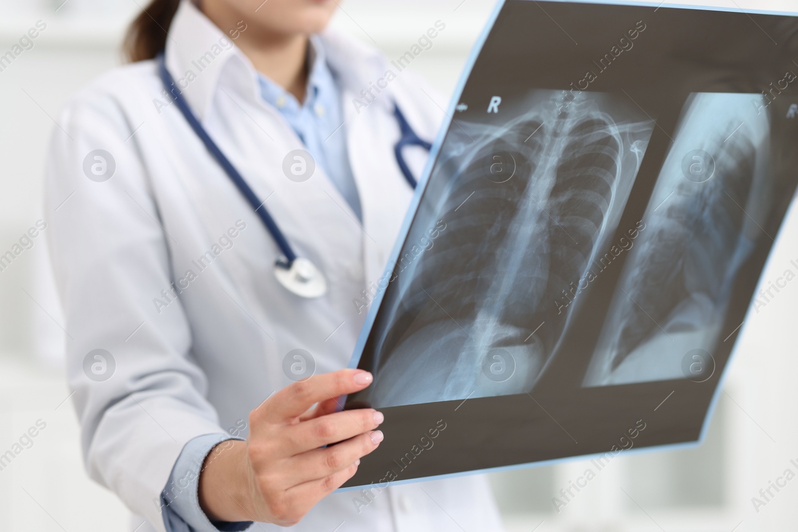 Photo of Lung disease. Doctor examining chest x-ray in clinic, closeup