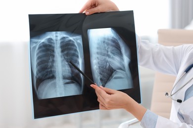 Photo of Lung disease. Doctor examining chest x-ray in clinic, closeup