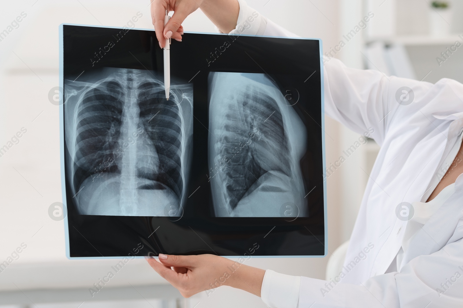 Photo of Lung disease. Doctor showing chest x-ray in clinic, closeup