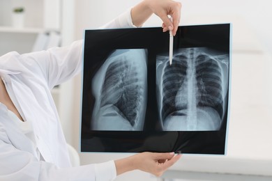 Lung disease. Doctor showing chest x-ray in clinic, closeup