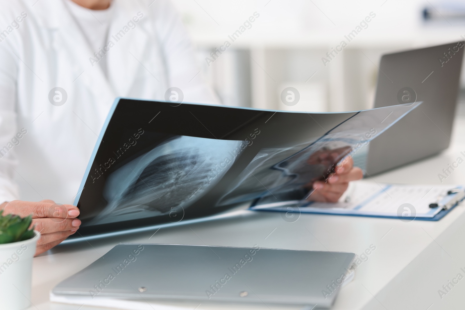 Photo of Lung disease. Doctor examining chest x-ray at table in clinic, closeup