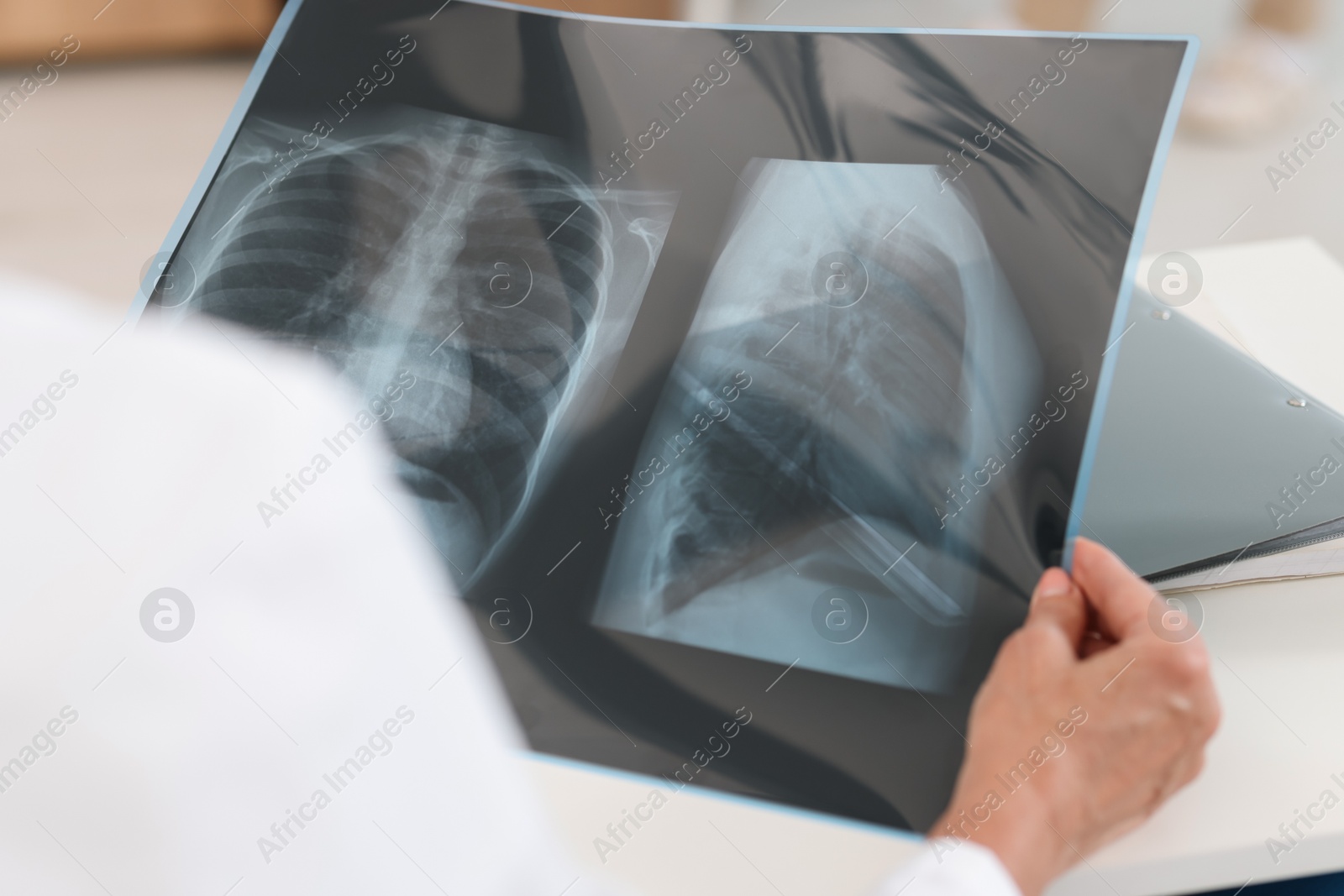 Photo of Lung disease. Doctor examining chest x-ray at table in clinic, closeup