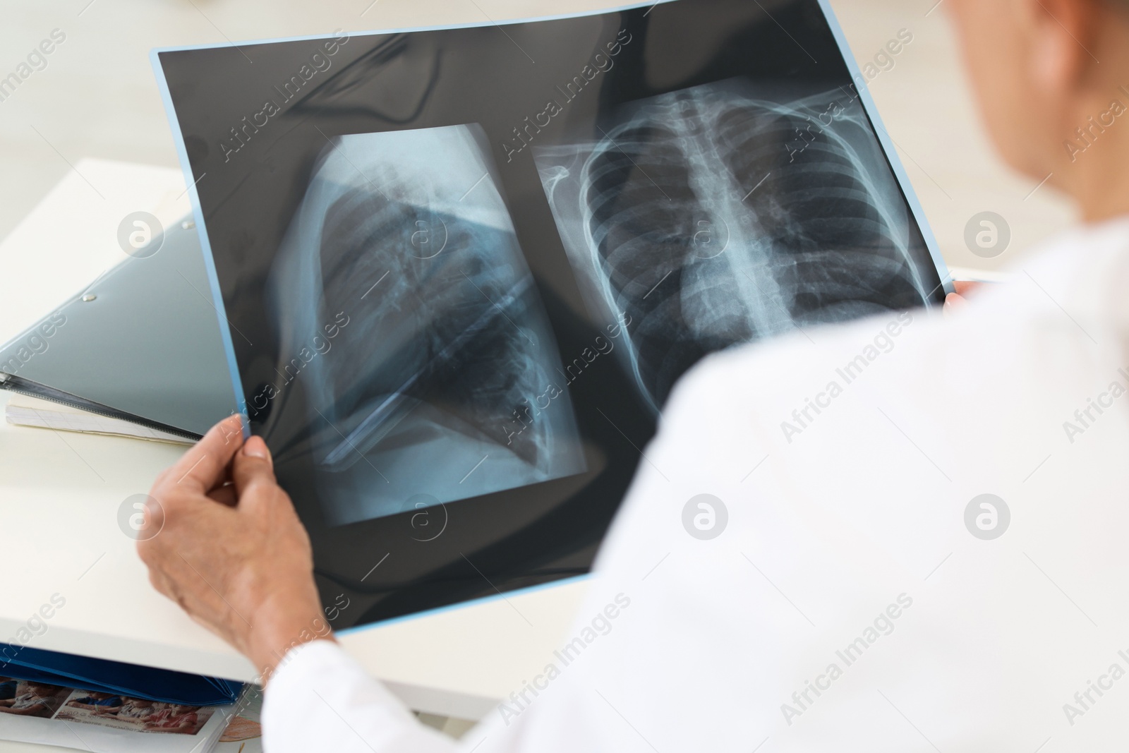 Photo of Lung disease. Doctor examining chest x-ray in clinic, closeup