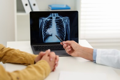 Lung cancer. Doctor showing chest x-ray on laptop to her patient in clinic, closeup