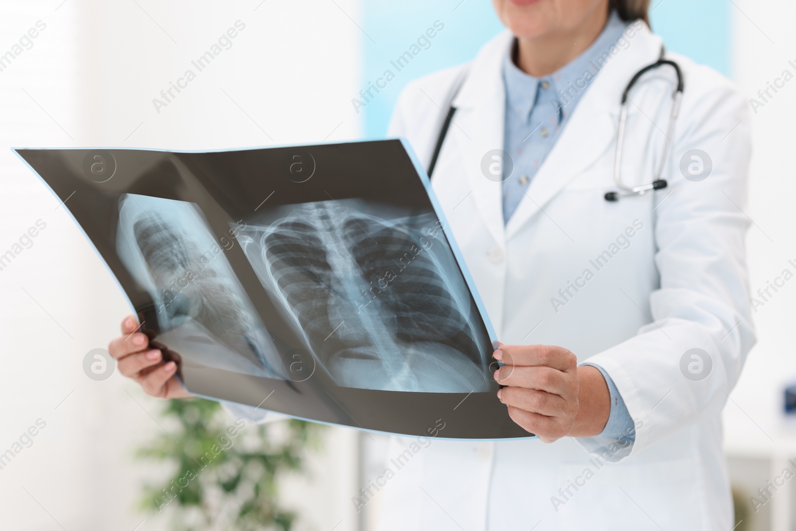 Photo of Lung disease. Doctor examining chest x-ray in clinic, closeup