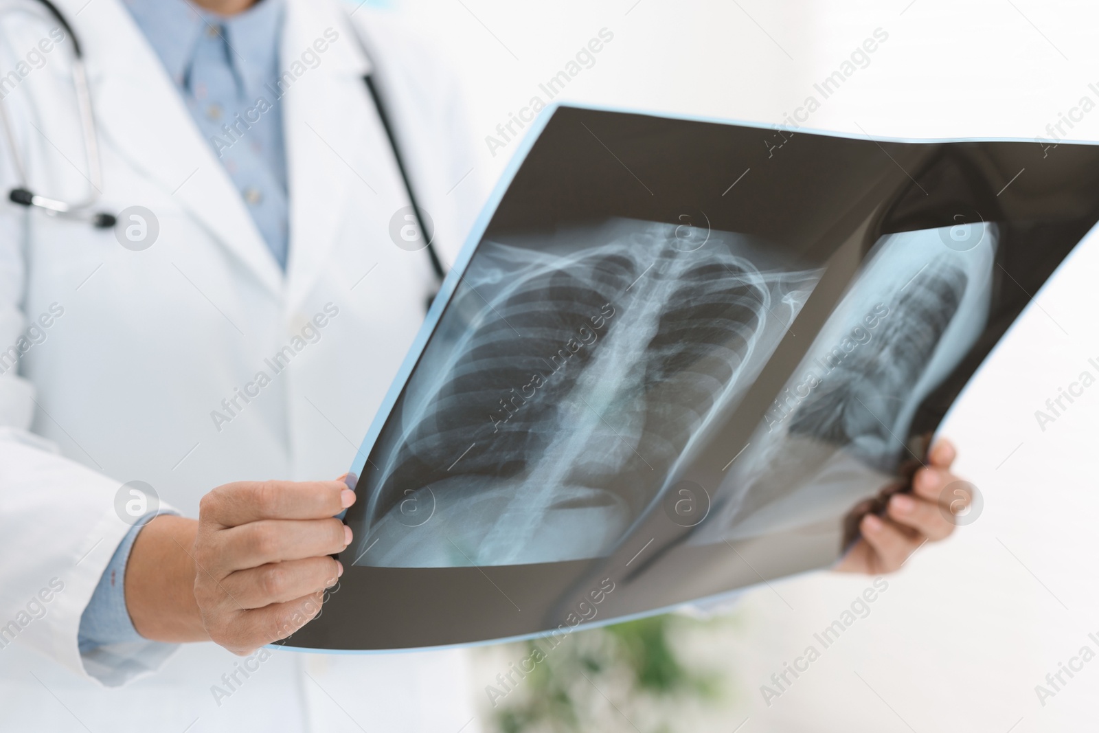 Photo of Lung disease. Doctor examining chest x-ray in clinic, closeup