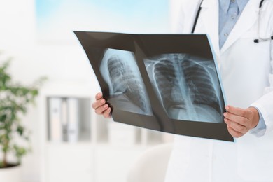 Photo of Lung disease. Doctor examining chest x-ray in clinic, closeup